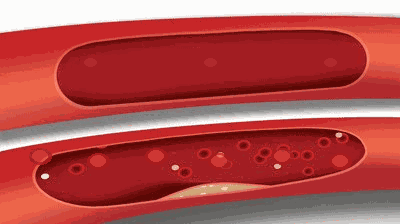 Animated illustration of blood cells moving through a vessel